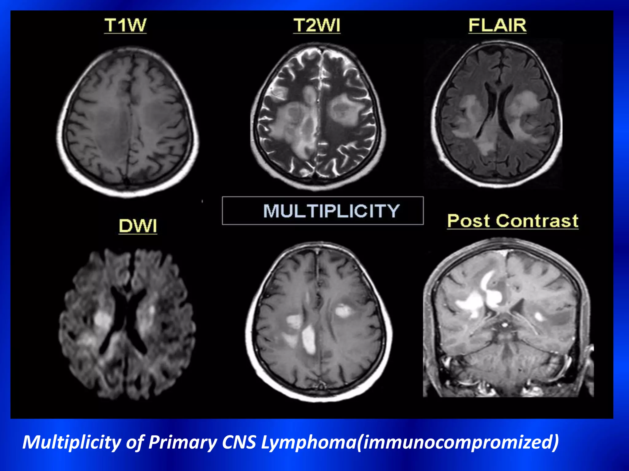 Multiplicity of Primary CNS Lymphoma(immunocompromized)
 
