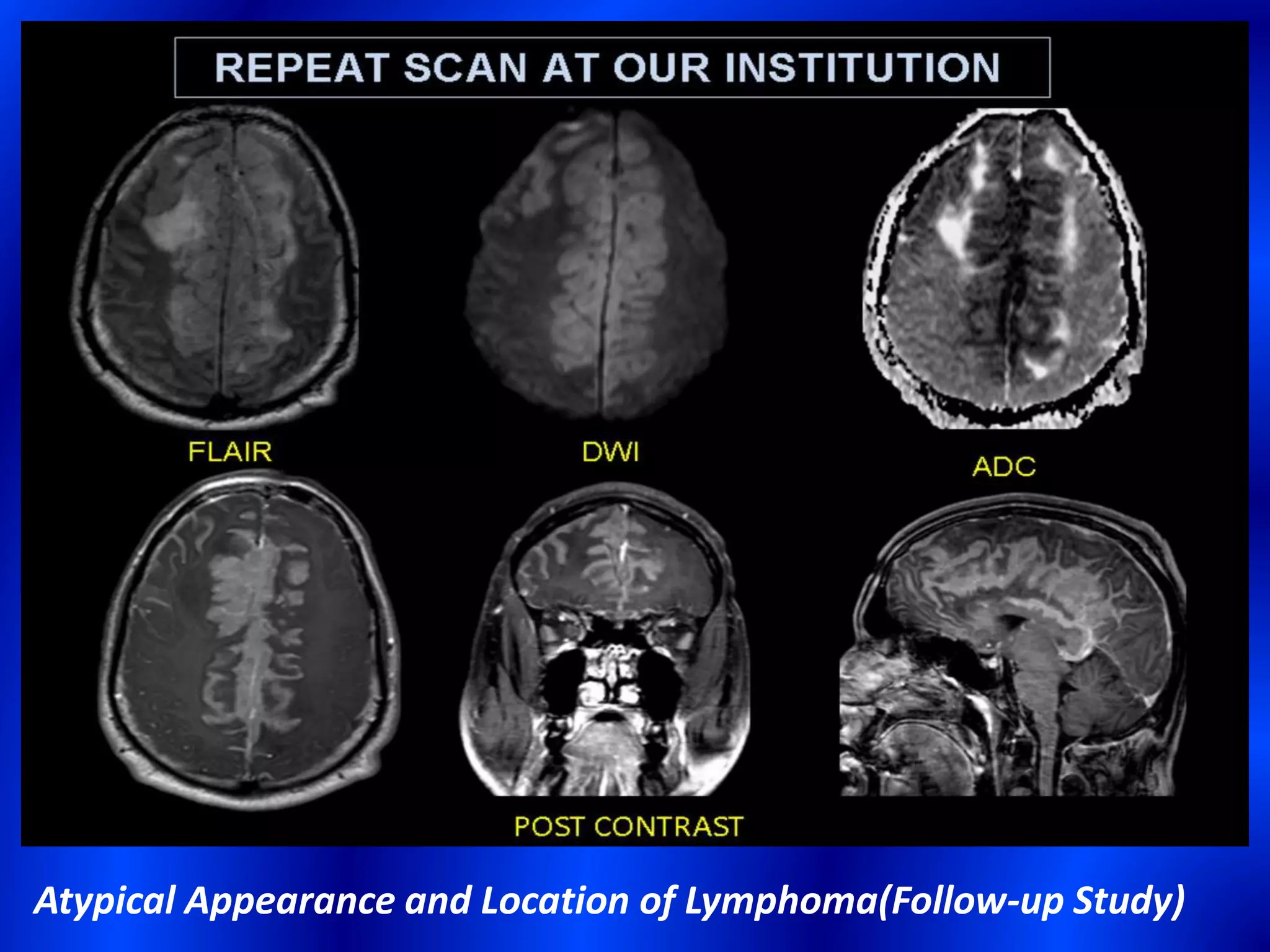 Atypical Appearance and Location of Lymphoma(Follow-up Study)
 