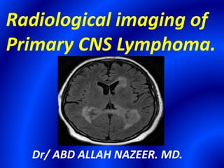 Radiological imaging of
Primary CNS Lymphoma.
Dr/ ABD ALLAH NAZEER. MD.
 