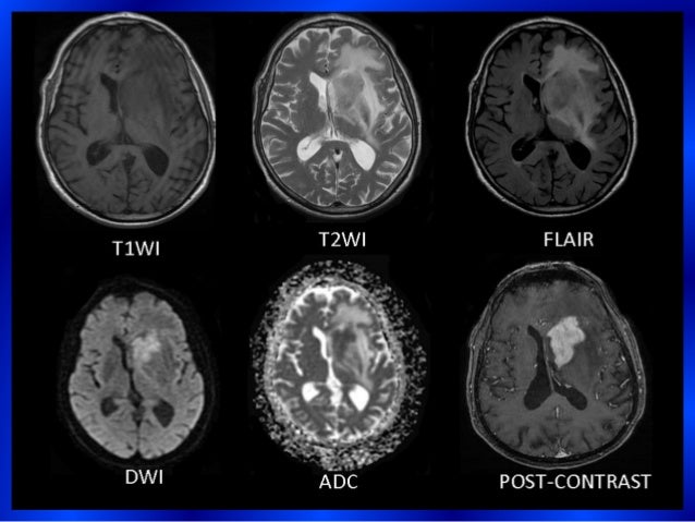 Presentation1.pptx, imaging modalities of intra cerebral lymphoma.