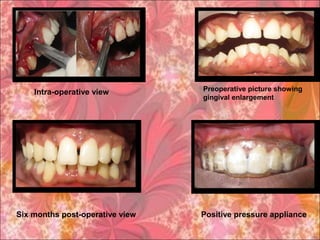 Preoperative picture showing
gingival enlargement
Intra-operative view
Positive pressure applianceSix months post-operative view
 