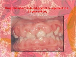 Drug (phenytoin)-induced gingival enlargement in a
12-year-old boy.
 