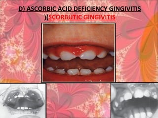 D) ASCORBIC ACID DEFICIENCY GINGIVITIS
(SCORBUTIC GINGIVITIS(
 