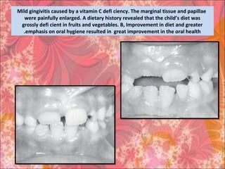 Mild gingivitis caused by a vitamin C defi ciency. The marginal tissue and papillae
were painfully enlarged. A dietary history revealed that the child’s diet was
grossly defi cient in fruits and vegetables. B, Improvement in diet and greater
emphasis on oral hygiene resulted in great improvement in the oral health.
 