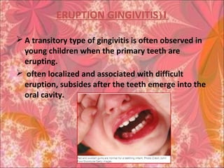1(ERUPTION GINGIVITIS
 A transitory type of gingivitis is often observed in
young children when the primary teeth are
erupting.
 often localized and associated with difficult
eruption, subsides after the teeth emerge into the
oral cavity.
 