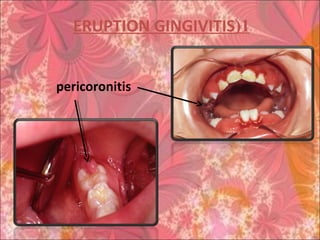 1(ERUPTION GINGIVITIS
pericoronitis
 