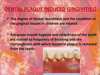 2(DENTAL PLAQUE INDUCED GINGIVITIS
 The degree of dental cleanliness and the condition of
the gingival tissues in children are related.
 Adequate mouth hygiene and cleanliness of the teeth
are related to frequency of brushing and the
thoroughness with which bacterial plaque is removed
from the teeth.
 