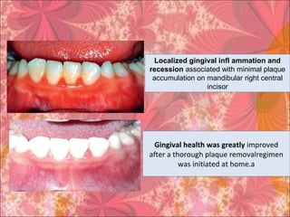 Gingival health was greatly improved
after a thorough plaque removalregimen
was initiated at home.a
Localized gingival infl ammation and
recession associated with minimal plaque
accumulation on mandibular right central
incisor
 