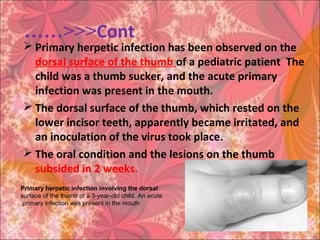 Cont……<<<
 Primary herpetic infection has been observed on the
dorsal surface of the thumb of a pediatric patient The
child was a thumb sucker, and the acute primary
infection was present in the mouth.
 The dorsal surface of the thumb, which rested on the
lower incisor teeth, apparently became irritated, and
an inoculation of the virus took place.
 The oral condition and the lesions on the thumb
subsided in 2 weeks.
Primary herpetic infection involving the dorsal
surface of the thumb of a 3-year-old child. An acute
primary infection was present in the mouth.
 