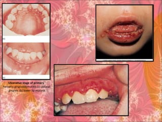 Ulcerative stage of primary
herpetic gingivostomatitis:(a) palatal
gingiva; (b) lower lip mucosa.
 
