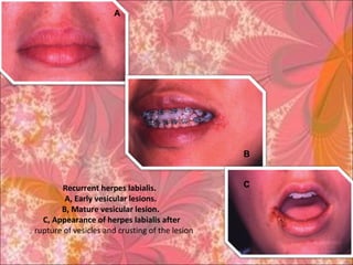 Recurrent herpes labialis.
A, Early vesicular lesions.
B, Mature vesicular lesion.
C, Appearance of herpes labialis after
rupture of vesicles and crusting of the lesion.
A
B
C
 
