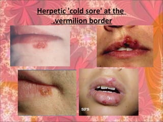 Herpetic 'cold sore' at the
vermilion border.
 