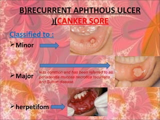 B)RECURRENT APHTHOUS ULCER
(CANKER SORE(
Classified to :
Minor
Major
herpetifom
less common and has been referred to as
periadenitis mucosa necrotica recurrens
and Sutton disease.
 