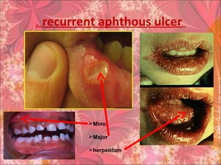 recurrent aphthous ulcer.
Minor
Major
herpetifom
 