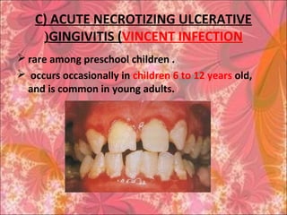 C) ACUTE NECROTIZING ULCERATIVE
GINGIVITIS (VINCENT INFECTION(
 rare among preschool children .
 occurs occasionally in children 6 to 12 years old,
and is common in young adults.
 