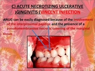 C) ACUTE NECROTIZING ULCERATIVE
GINGIVITIS (VINCENT INFECTION(
ANUG can be easily diagnosed because of the involvement
of the interproximal papillae and the presence of a
pseudomembranous necrotic covering of the marginal
tissue
 