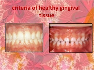 criteria of healthy gingival
tissue
 