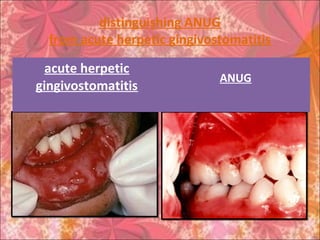 distinguishing ANUG
from acute herpetic gingivostomatitis
acute herpetic
gingivostomatitis
ANUG
 