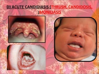 D) ACUTE CANDIDIASIS (THRUSH, CANDIDOSIS,
MONILIASIS(
 