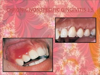 5(CHRONIC NONSPECIFIC GINGIVITIS
 