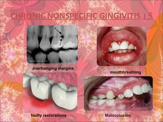 5(CHRONIC NONSPECIFIC GINGIVITIS
Malocclusionfaulty restorations
overhanging margins
mouthbreathing
 
