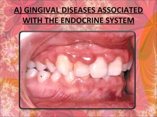 A) GINGIVAL DISEASES ASSOCIATED
WITH THE ENDOCRINE SYSTEM
 