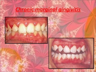Chronic marginal gingivitis
 