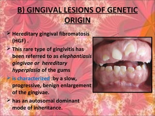 B) GINGIVAL LESIONS OF GENETIC
ORIGIN
 Hereditary gingival fibromatosis
(HGF) .
 This rare type of gingivitis has
been referred to as elephantiasis
gingivae or hereditary
hyperplasia of the gums
 is characterized :by a slow,
progressive, benign enlargement
of the gingivae.
 has an autosomal dominant
mode of inheritance.
 