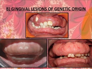 B) GINGIVAL LESIONS OF GENETIC ORIGIN
 