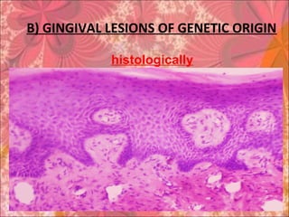 B) GINGIVAL LESIONS OF GENETIC ORIGIN
histologically
 