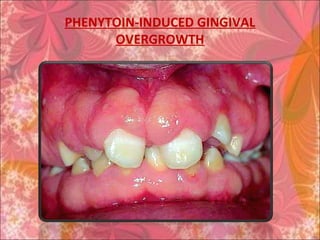 PHENYTOIN-INDUCED GINGIVAL
OVERGROWTH
 