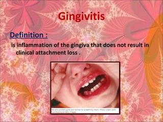 Gingivitis
Definition :
is inflammation of the gingiva that does not result in
clinical attachment loss .
 