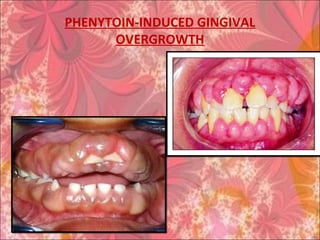 PHENYTOIN-INDUCED GINGIVAL
OVERGROWTH
 