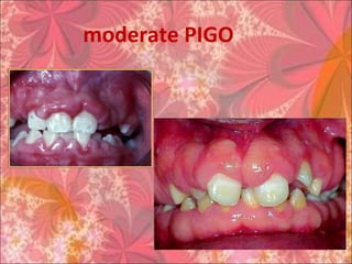 moderate PIGO
 