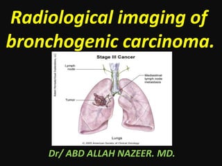Radiological imaging of
bronchogenic carcinoma.
Dr/ ABD ALLAH NAZEER. MD.
 