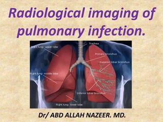 Radiological imaging of
pulmonary infection.
Dr/ ABD ALLAH NAZEER. MD.
 