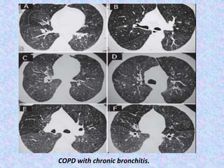 COPD with chronic bronchitis.
 