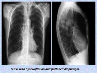 COPD with hyperinflation and flattened diaphragm.
 