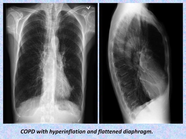 Presentation1.pptx, radiological imaging of copd. | PPTX | Lung and ...