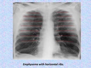 Emphysema with horizontal ribs.
 