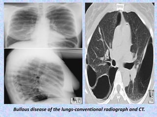Bullous disease of the lungs-conventional radiograph and CT.
 