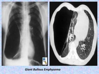 Giant Bullous Emphysema
 