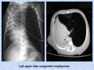 Left upper lobe congenital emphysema.
 