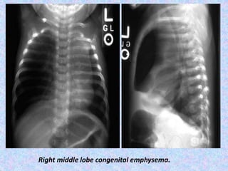 Right middle lobe congenital emphysema.
 