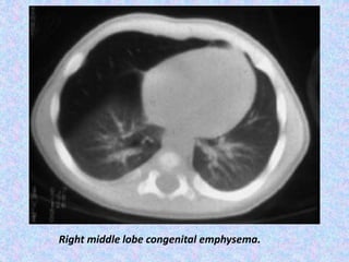 Right middle lobe congenital emphysema.
 