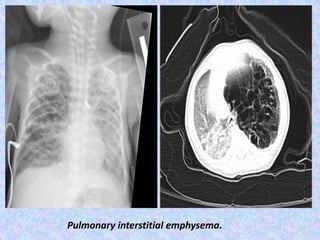 Pulmonary interstitial emphysema.
 