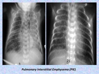 Pulmonary Interstitial Emphysema (PIE)
 