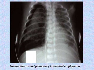 Pneumothorax and pulmonary interstitial emphysema
 