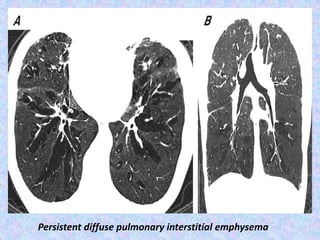 Persistent diffuse pulmonary interstitial emphysema
 