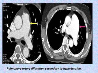 Pulmonary artery dilatation secondary to hypertension.
 